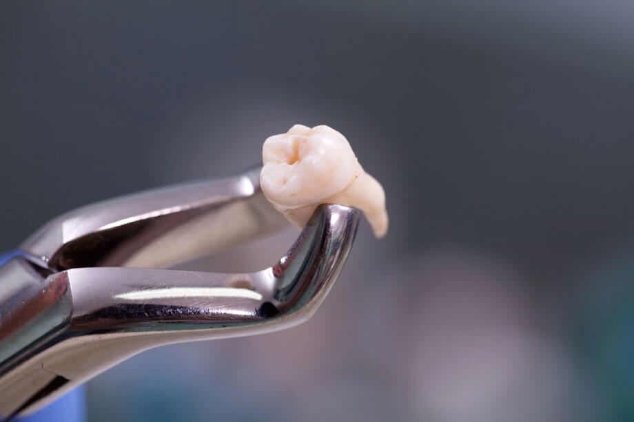 Удаление и резекция зуба мудрости: обеспечиваем здоровье полости рта