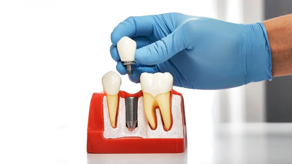 имплантація зуба
