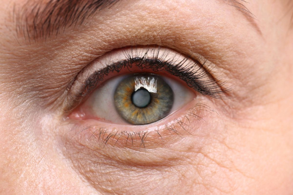 Хірургічне лікування катаракти – що треба знати