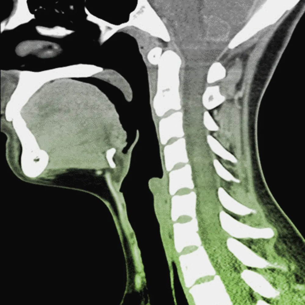 кт шийного відділу хребта